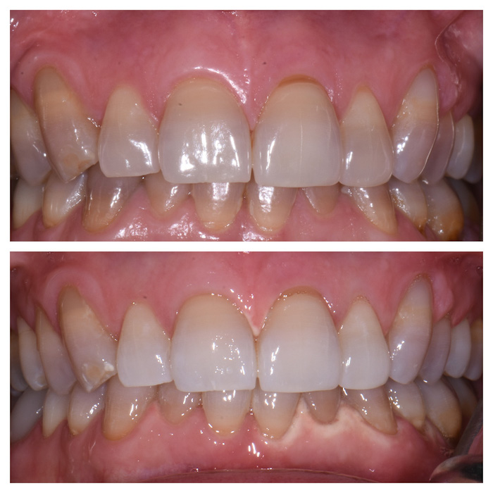 Before & After Kor Whitening with Tetracycline Stain