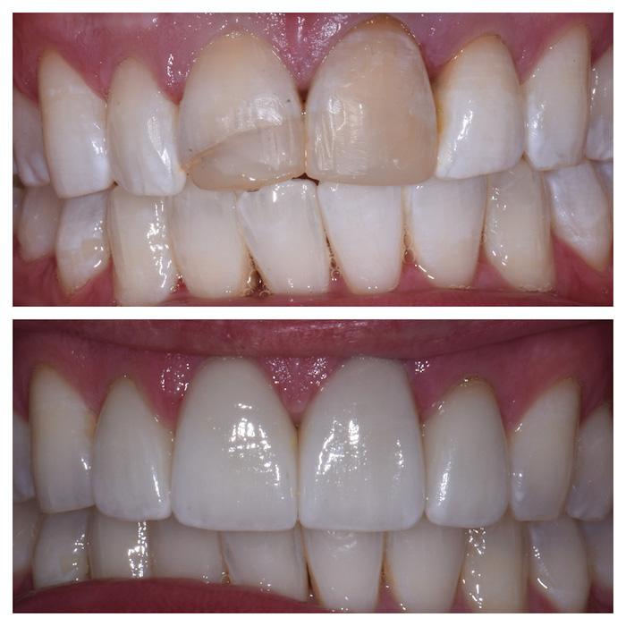 Before & After Anterior Crowns